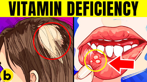 9 Early Warning Signs Of Vitamin Deficiency