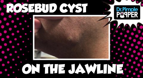 Rosebud Cyst on The Jawline