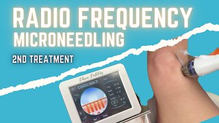 RF Microneedling my LEGS for Fat Loss and Skin Tightening - ROUND #2 #skintightening