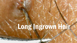 Long Ingrown Hair