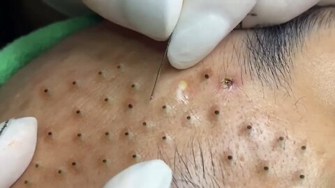 Removing Acne and Blackheads Treatment, #24