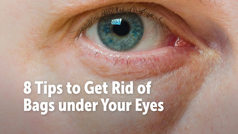 8 Tips to Get Rid of Bags under Your Eyes