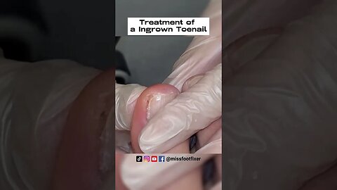 Wide Nail Correction 2023 | Treatment of a Ingrown Toenail by foot specialist miss foot fixer