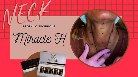 Miracle H ~ Sassy Neck Lift ~ Profhilo injection technique