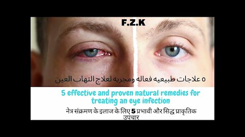 5 effective and proven natural remedies for treating an eye infection (eye infection) at home