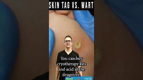 Skin Tags vs Warts Removal? [How To Get Rid Of Skin Tags & Warts]