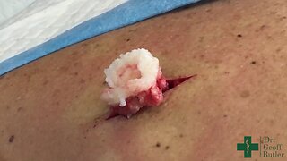 Removal of an Epidermal cyst on the upper back