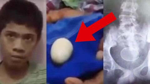 Indonesian Boy ‘Laid 20 CHICKEN Eggs Since 2015’ BAFFLES Doctors