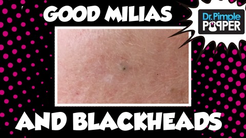 Dr Pimple Popper: Excellent Milia & Blackheads...