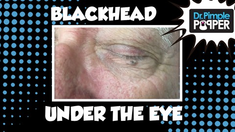 Now, THAT'S a BLACKHEAD!!