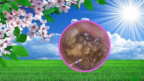 Cholesteatoma Earwax Removal #12