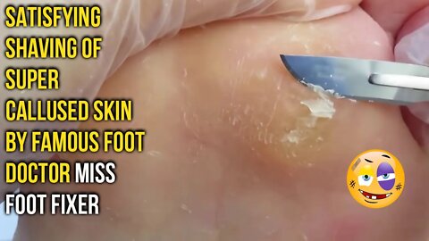 SATISFYING SHAVING OF SUPER CALLUSED SKIN BY FAMOUS FOOT DOCTOR MISS FOOT FIXER