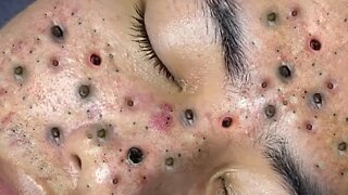 BIG DEEP BLACKHEADS REMOVAL #blackheads #mitesser