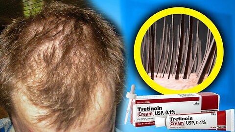 Can Tretinoin Reactivate follicles When Combined with Minoxidil?