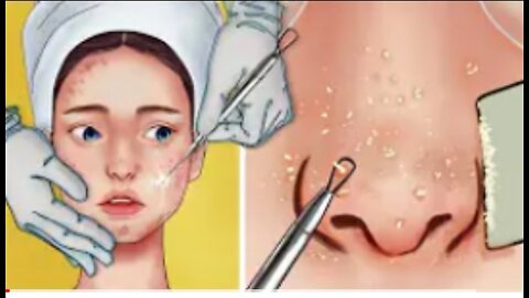 Spa treatment ll asmr animation ll pimples poppings