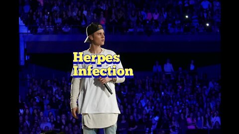 Justin bieber's Herpes Activation