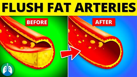 Top 10 Ways to Flush Fat Out of Your Arteries ❤️‍🔥