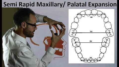 Mechanism of Semi Rapid Palatal, Maxillary Expansion & Teeth Position on Arches by Dr Mike Mew