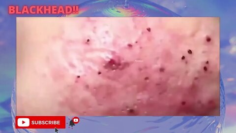 Removal / Extraction of blackheads and pimples. blackhead treatment