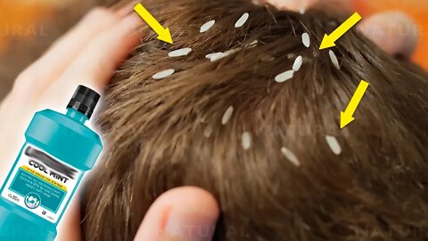 Get Rid of Head Lice With Only One Ingredient