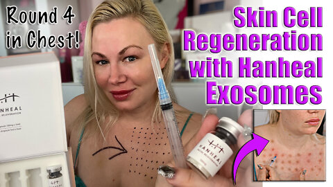 Skin Cell Regeneration with Hanheal Exosomes from Acecosm, Round 4 | Code Jessica10 Saves you Money!