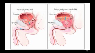 MEN'S WHO SUFFER FROM HAVING ENLARGED PROSTATE AND WANTS TO INCREASE URINE FLOW.