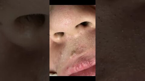 FULL Blackheads Lips Operation