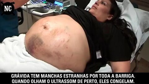 Grávida tem manchas estranhas por toda a barriga. Quando olham o ultrassom de perto, eles congelam