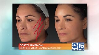 Contour Medical can give you a facelift without having surgery!