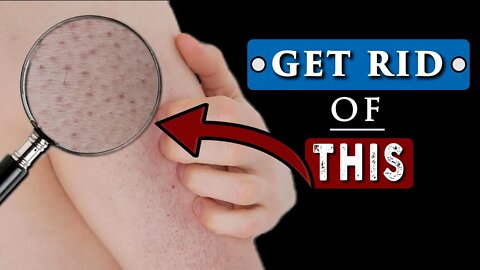 How to GET RID of WHITE BUMPS on ARMS? || KERATOSIS PILARIS