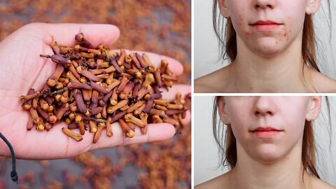 Start Consuming Cloves For Amazing Health Benefits