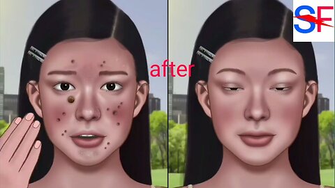 ASMR sebum explosion! Care for Blackhead & skin wart removal 3D animation video🙏