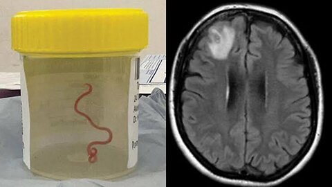 UNBELIEVABLE Live Worm Removed from Woman's Brain -