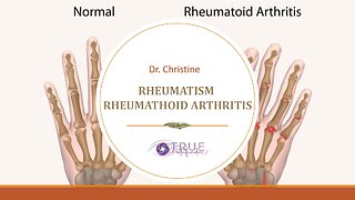 RHEUMATISM AND RHEUMATHOID ARTHRITIS - THE PSYCHOSOMATIC CAUSES | True Pathfinder