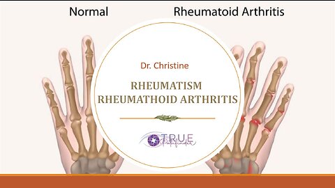 RHEUMATISM AND RHEUMATHOID ARTHRITIS - THE PSYCHOSOMATIC CAUSES | True Pathfinder