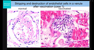 Finally: Indisputable evidence that the "vaccines" damage internal organs (blood vessels, brain)