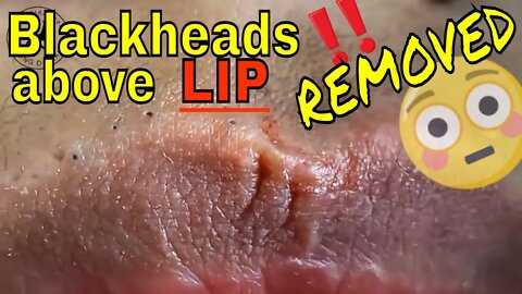 Multiple blackheads above lips getting removed 😳🪱 #blackheadremoval #blackhead #blackheads #fyp