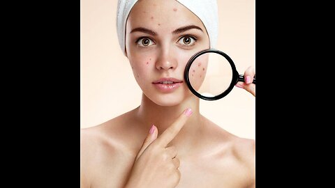 Reduce Your Acne Scars