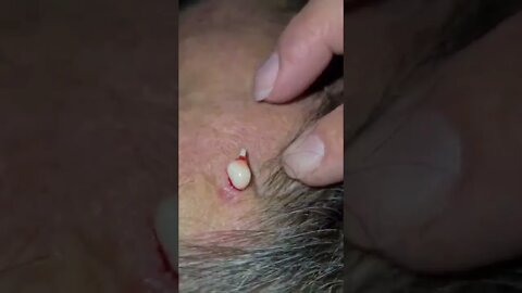 Stubborn Cyst Removal. Whiteheads and Blackheads Removal. | Oddly Satisfying Videos