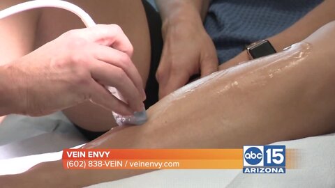 Dealing with spider or varicose veins? Discover the Vein Envy difference TODAY