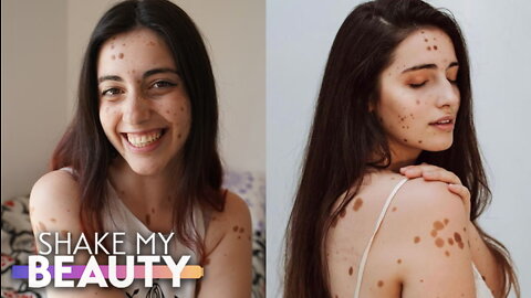 My Body Is Covered In 1,200 Moles | SHAKE MY BEAUTY
