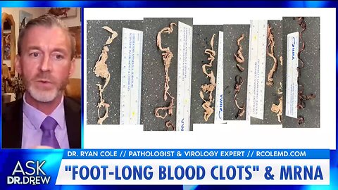 Dr. Ryan Cole - "Foot-Long Blood Clots" From mRNA
