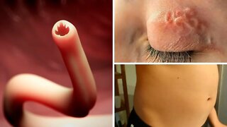 8 Signs You May Have Parasites In Your Body