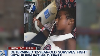 Determined boy survives flesh eating disease