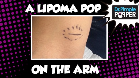 A Lipoma With High Expectations!