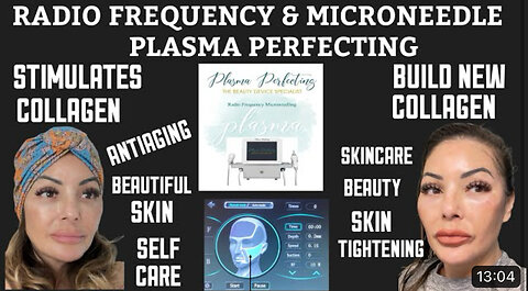 New RF Microneedling Machine. My Results Are Amazing With Only One Treatment. From Plasma Perfecting