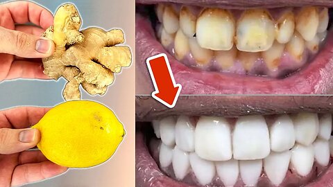 In just 2 MINUTES YELLOW dirty Teeth become Milky WHITE and Shiny🤯💥