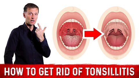 How To Get Rid of Painful Swollen Tonsils (Tonsillitis)? – Dr. Berg