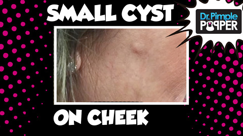 Small cyst on right cheek excised with suspension stitch