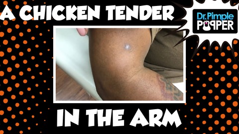 A Chicken Tender in the Arm